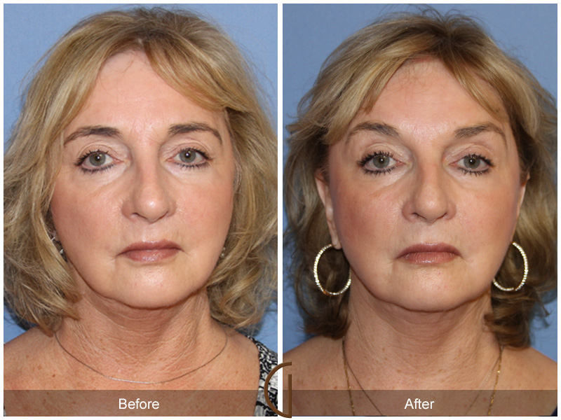 Laser Procedures Before & After Image