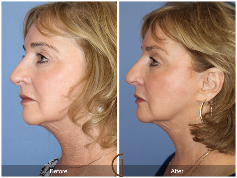 Laser Procedures Before & After Image