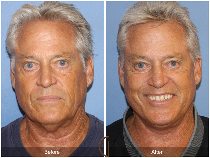 Male Facelift Before & After Image