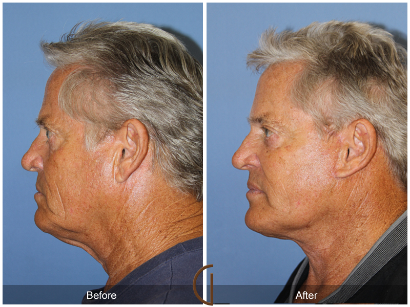 Male Facelift Before & After Image