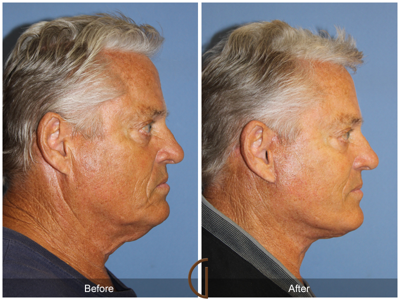 Male Facelift Before & After Image