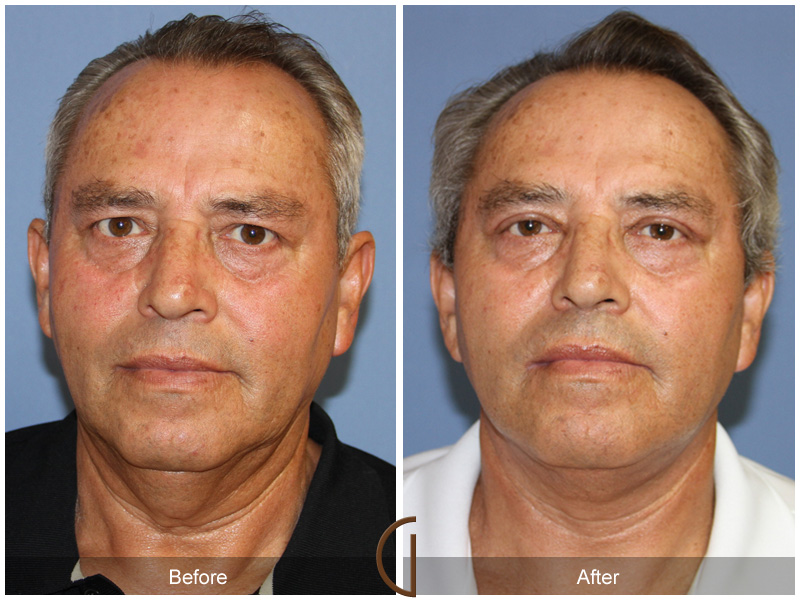 Male Facelift Before & After Image