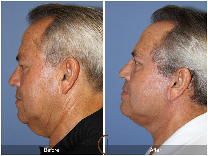 Male Facelift Before & After Image