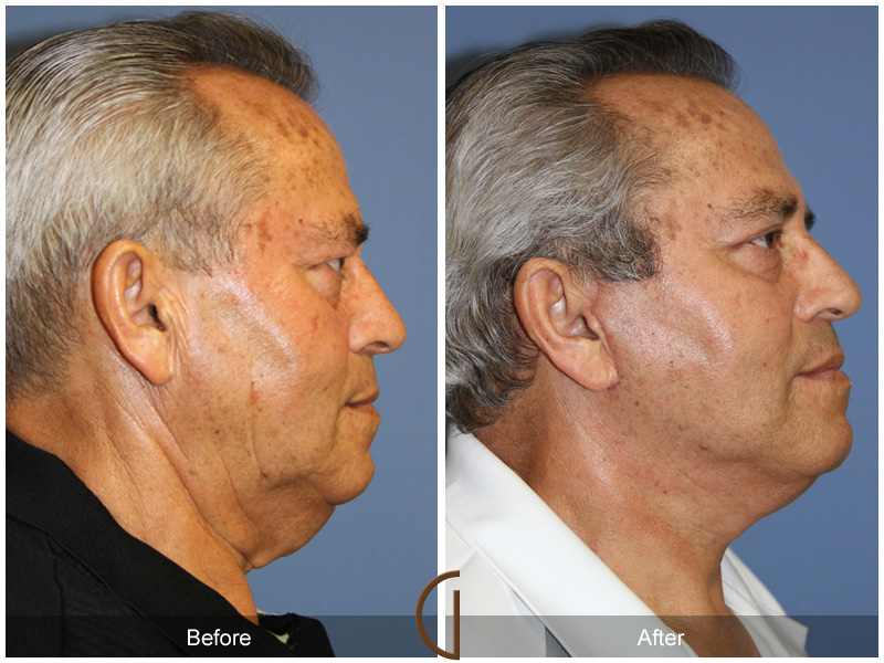 Male Facelift Before & After Image