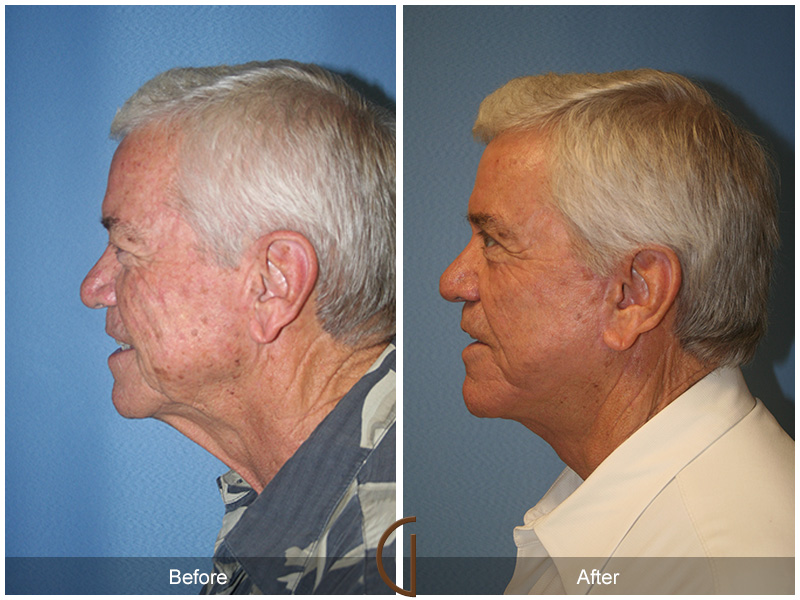 Male Facelift Before & After Image