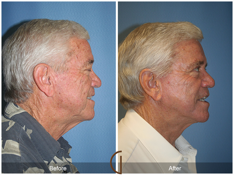 Male Facelift Before & After Image