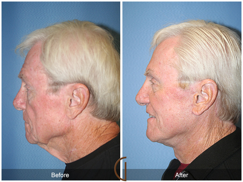 Male Facelift Before & After Image