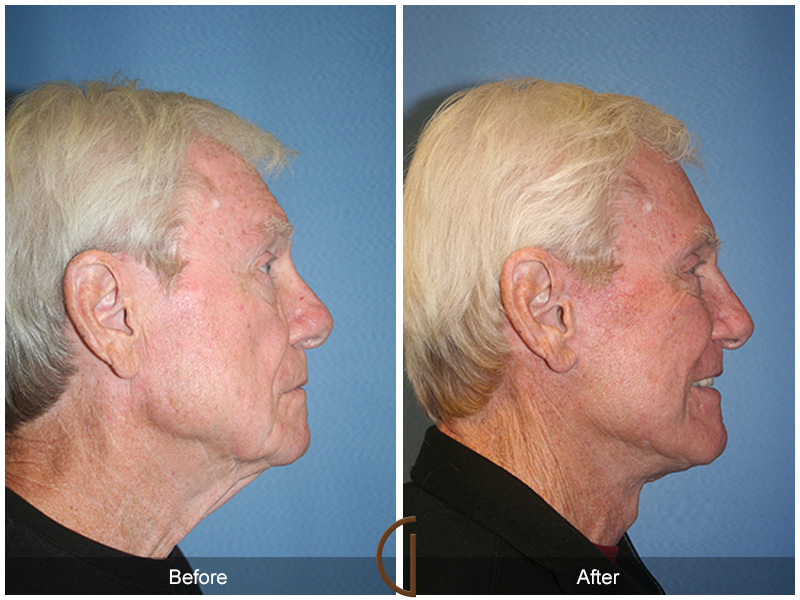 Male Facelift Before & After Image