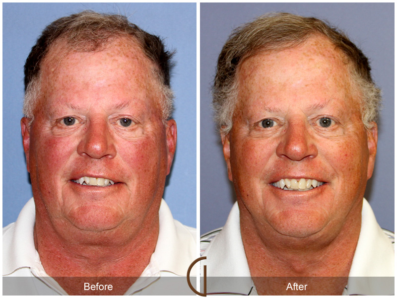 Male Facelift Before & After Image