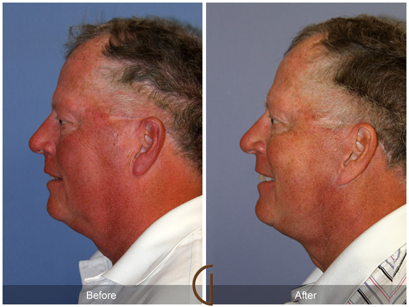 Male Facelift Before & After Image