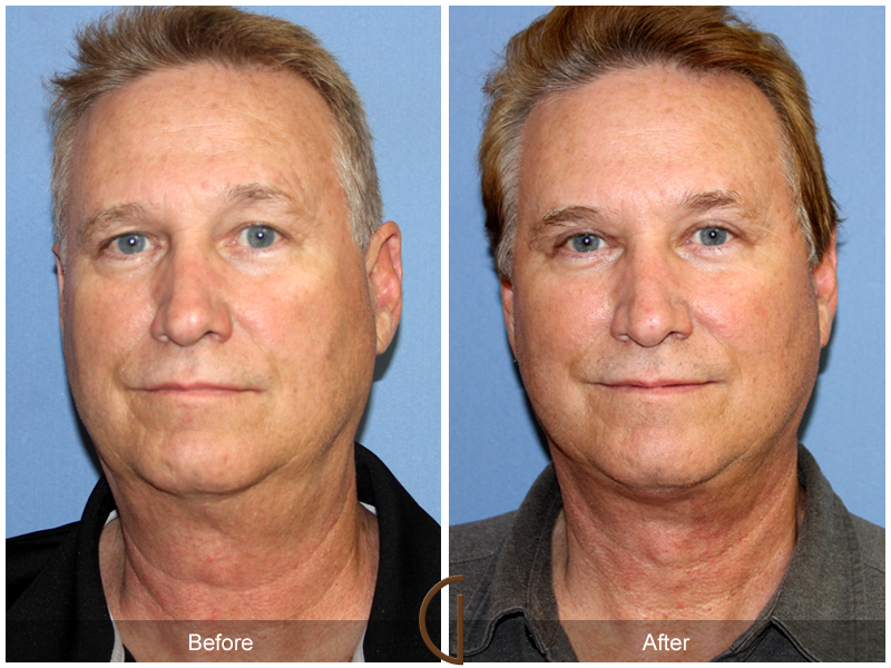 Male Facelift Before & After Image