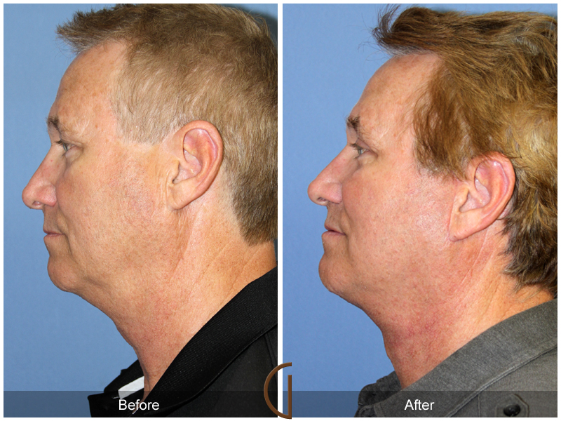 Male Facelift Before & After Image