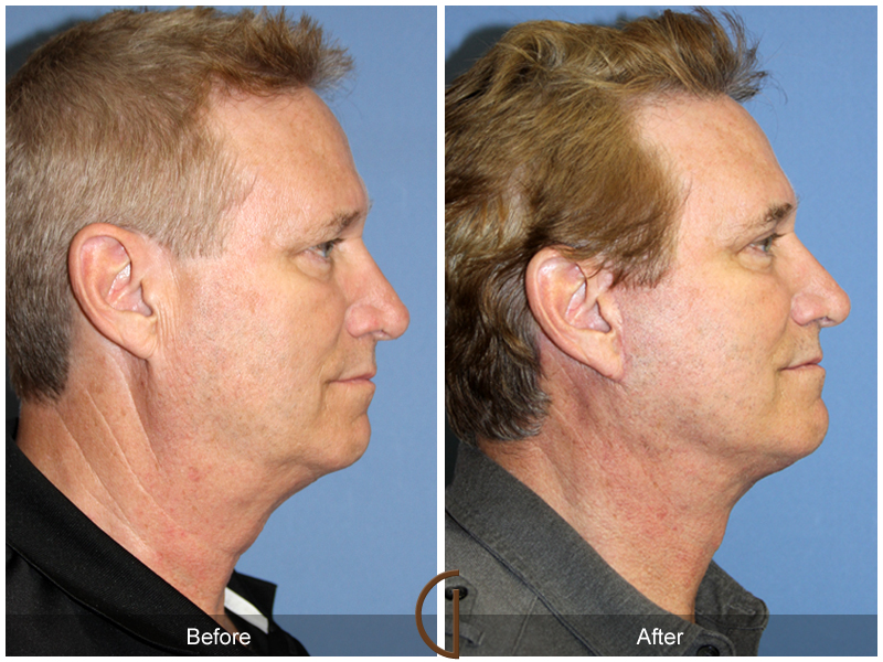 Male Facelift Before & After Image