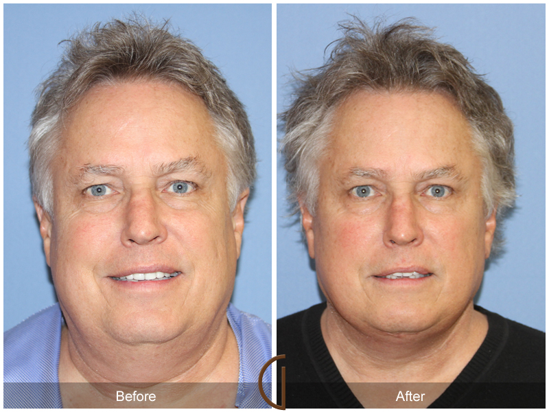 Male Facelift Before & After Image