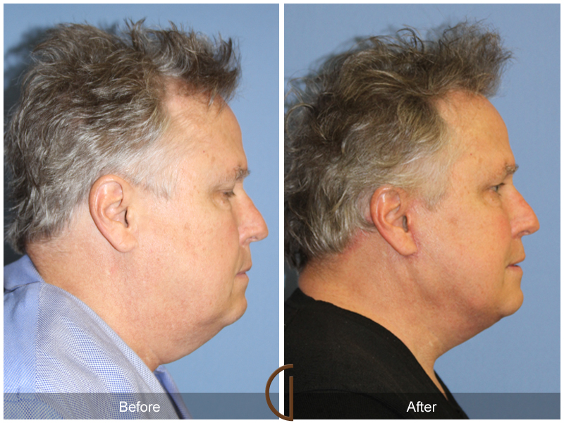 Male Facelift Before & After Image