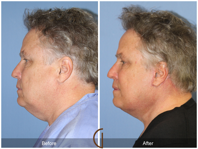 Male Facelift Before & After Image