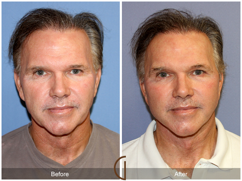 Male Facelift Before & After Image