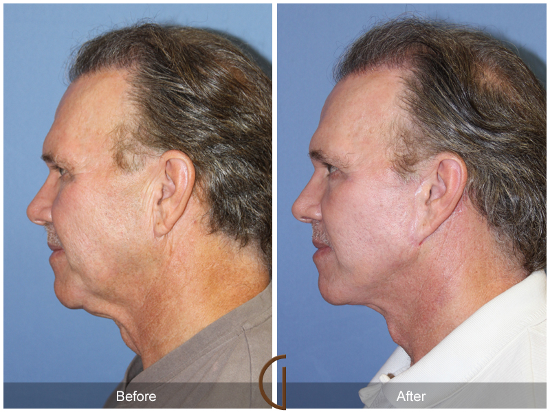 Male Facelift Before & After Image