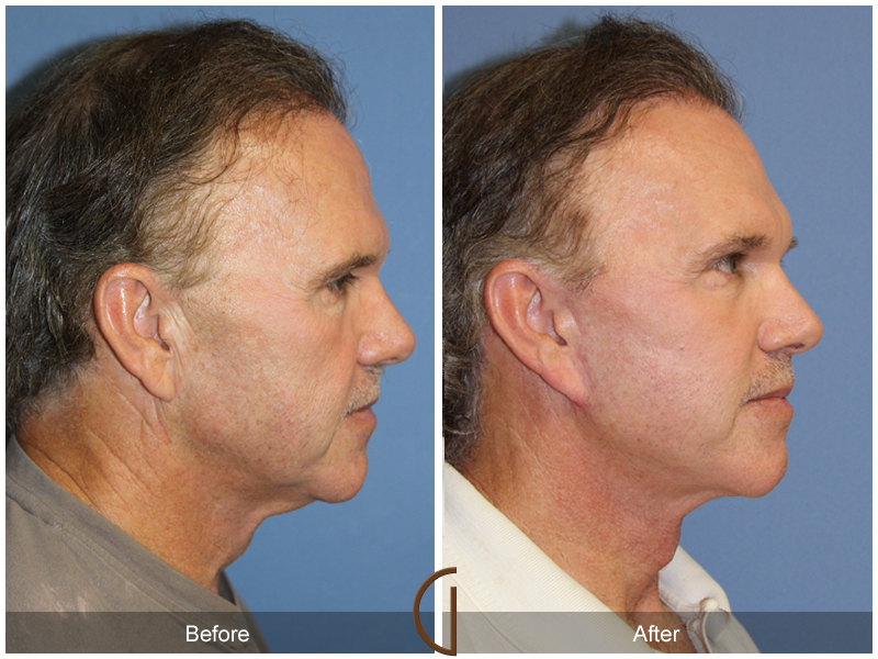 Male Facelift Before & After Image