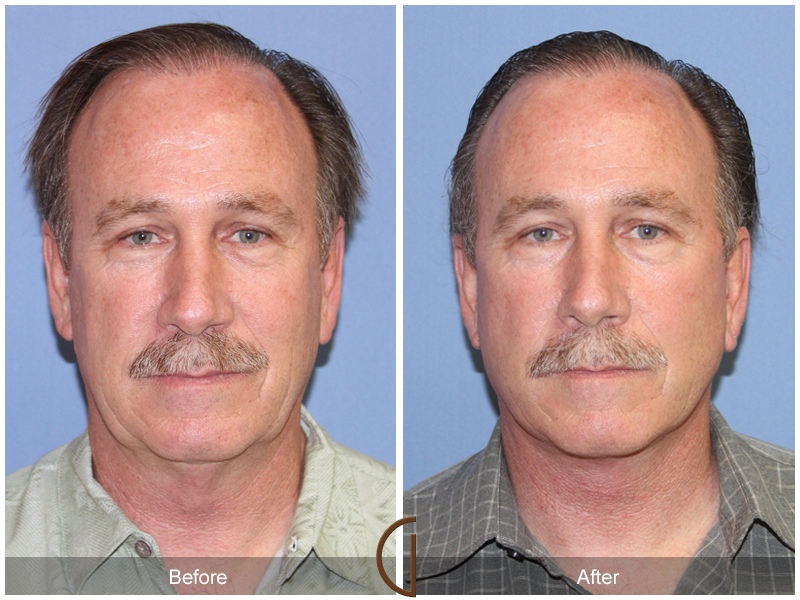 Male Facelift Before & After Image