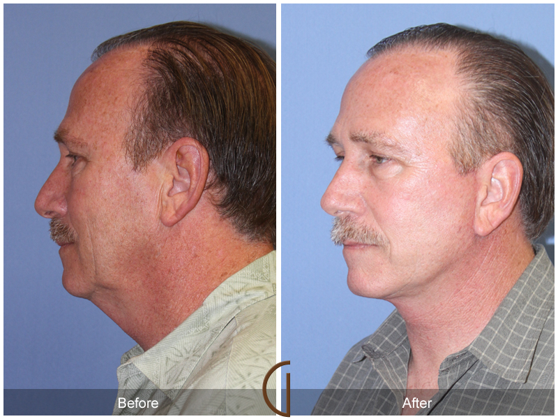 Male Facelift Before & After Image