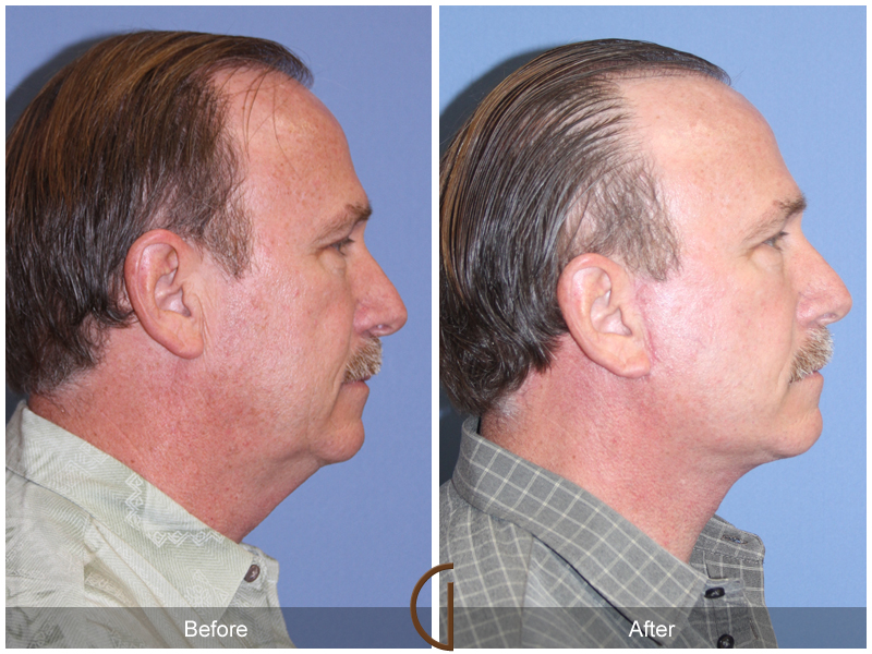 Male Facelift Before & After Image