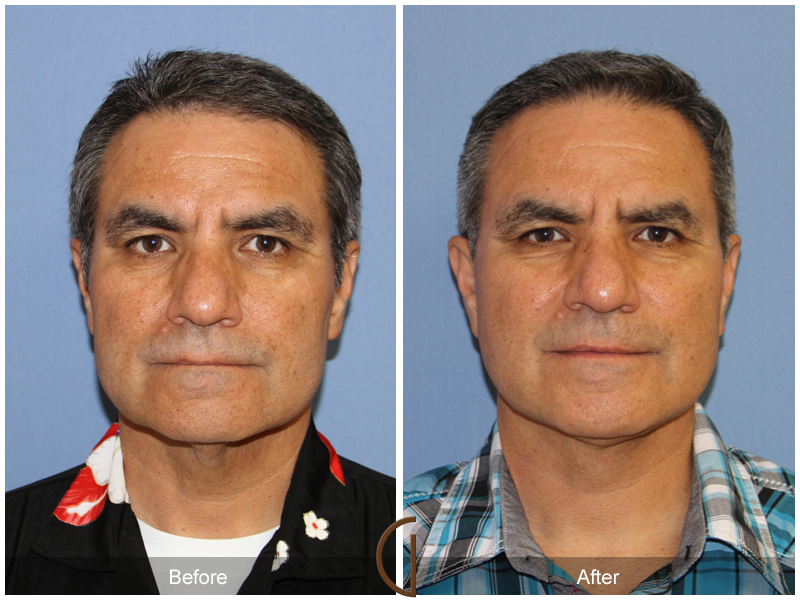 Male Facelift Before & After Image