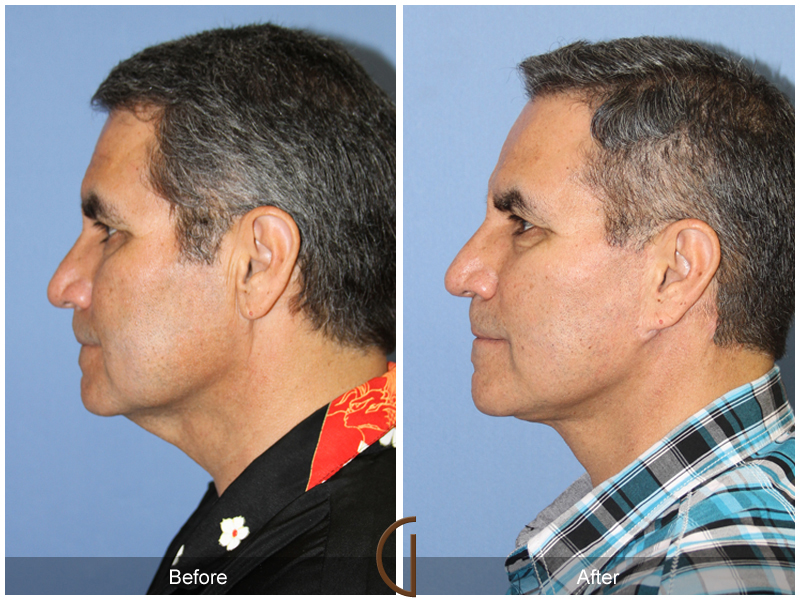 Male Facelift Before & After Image