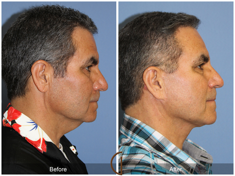 Male Facelift Before & After Image