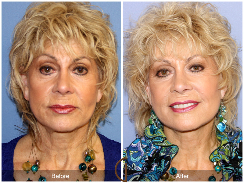 Revision Facelift Before & After Image