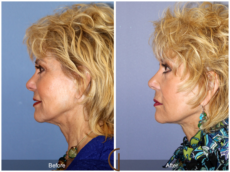 Revision Facelift Before & After Image