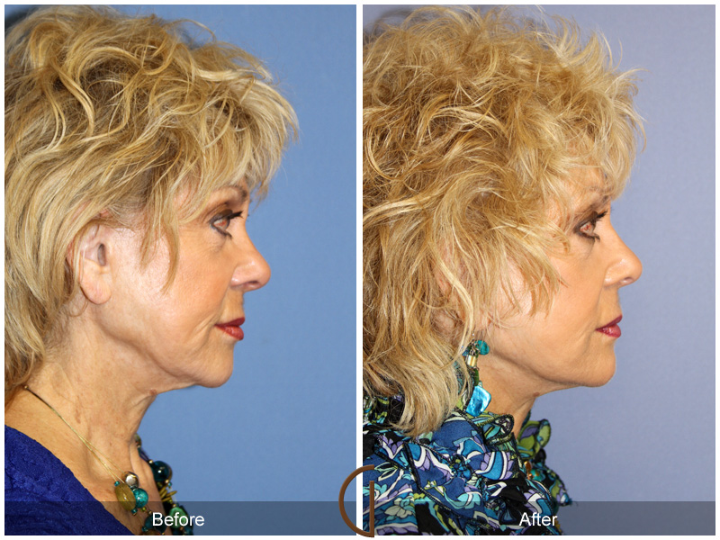 Revision Facelift Before & After Image