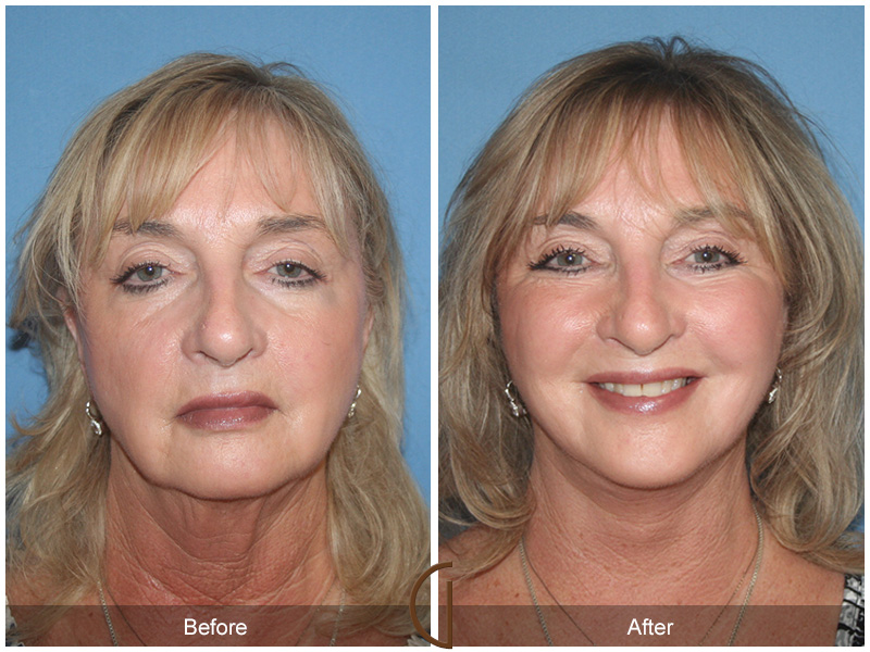 Revision Facelift Before & After Image