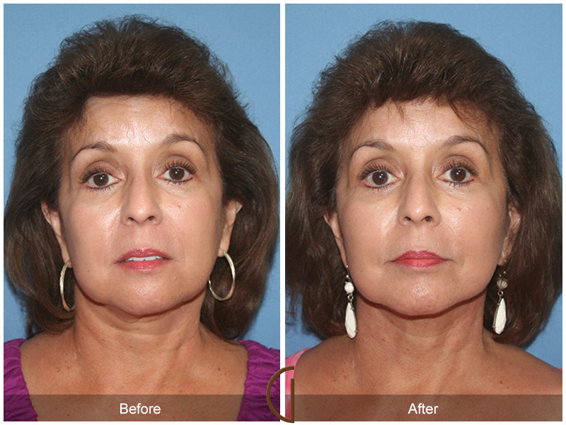 Revision Facelift Before & After Image