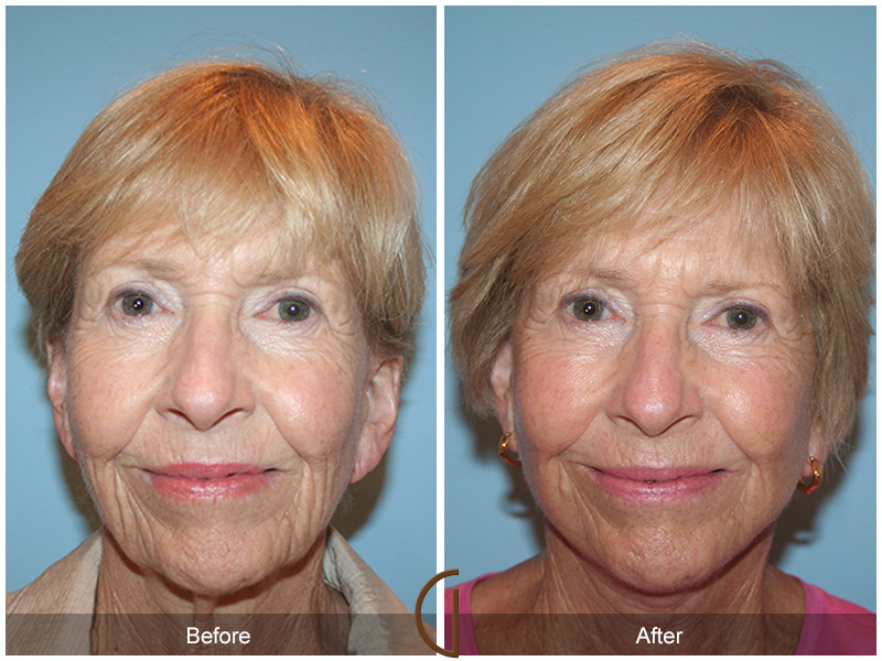 Revision Facelift Before & After Image