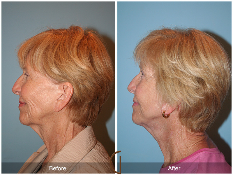 Revision Facelift Before & After Image