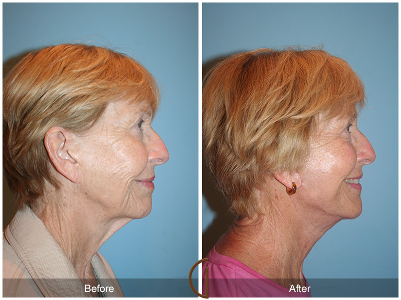 Revision Facelift Before & After Image