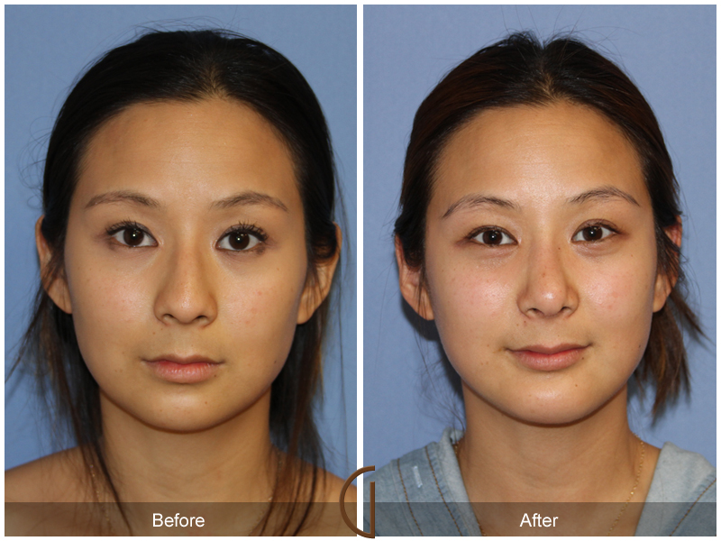 Ethnic Before & After Image