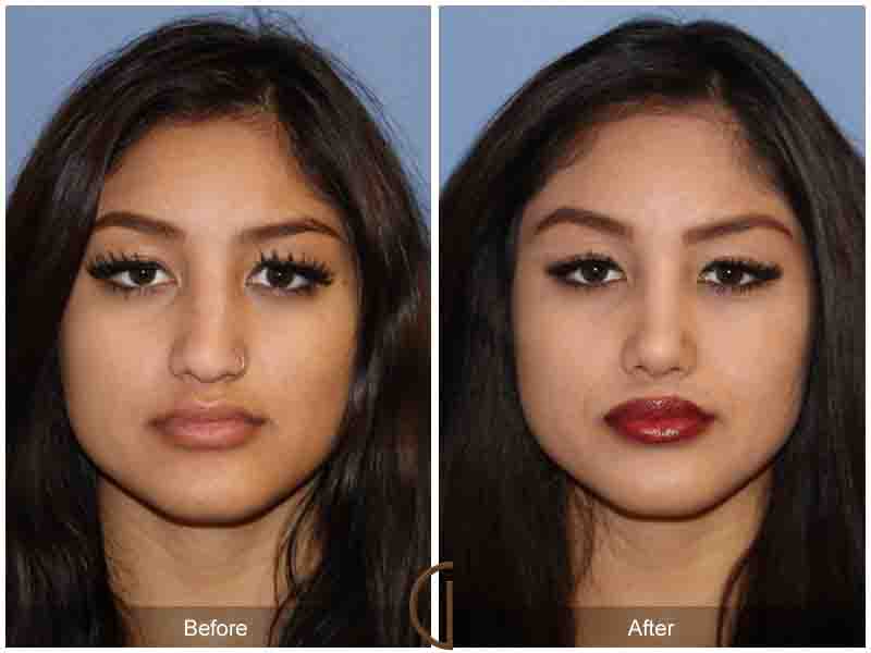 Ethnic Before & After Image