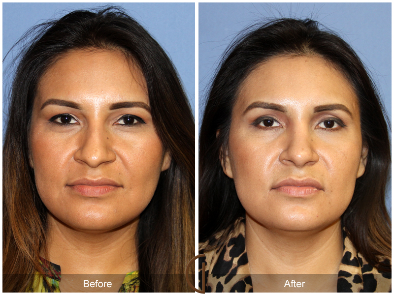 Ethnic Before & After Image