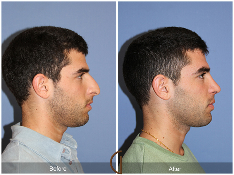 Ethnic Before & After Image