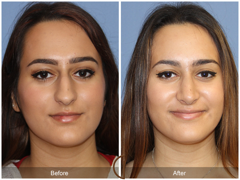 Ethnic Before & After Image