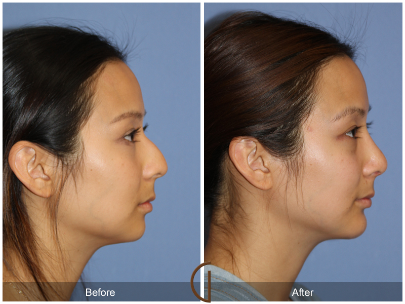 Female Rhinoplasty Before & After Image