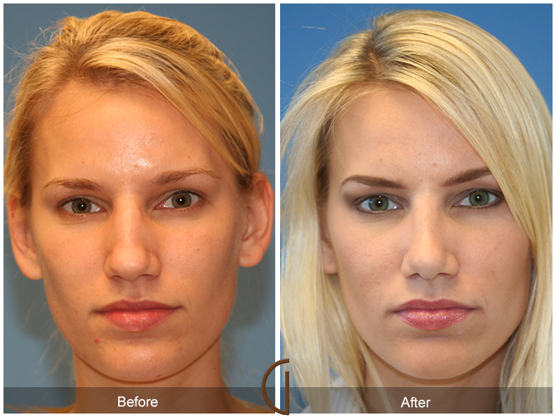 Female Rhinoplasty Before & After Image