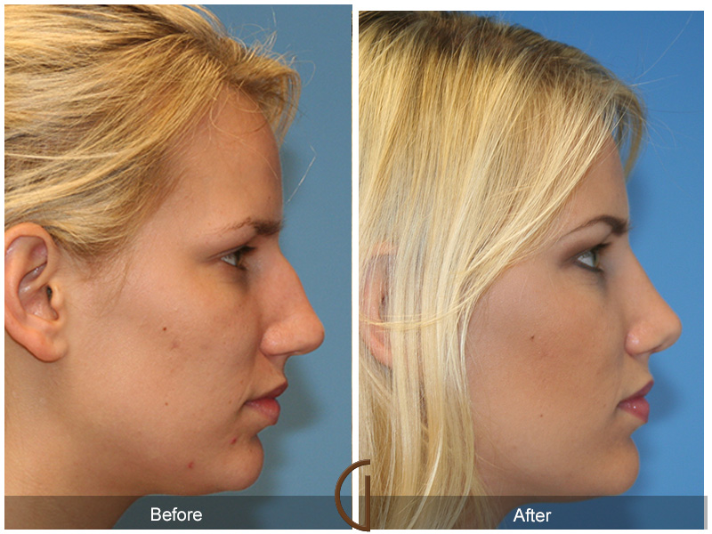 Female Rhinoplasty Before & After Image