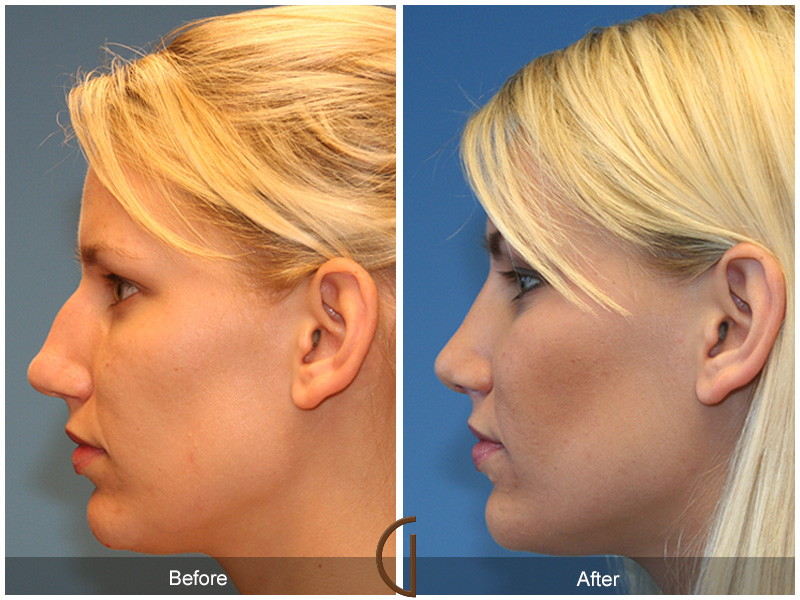 Female Rhinoplasty Before & After Image