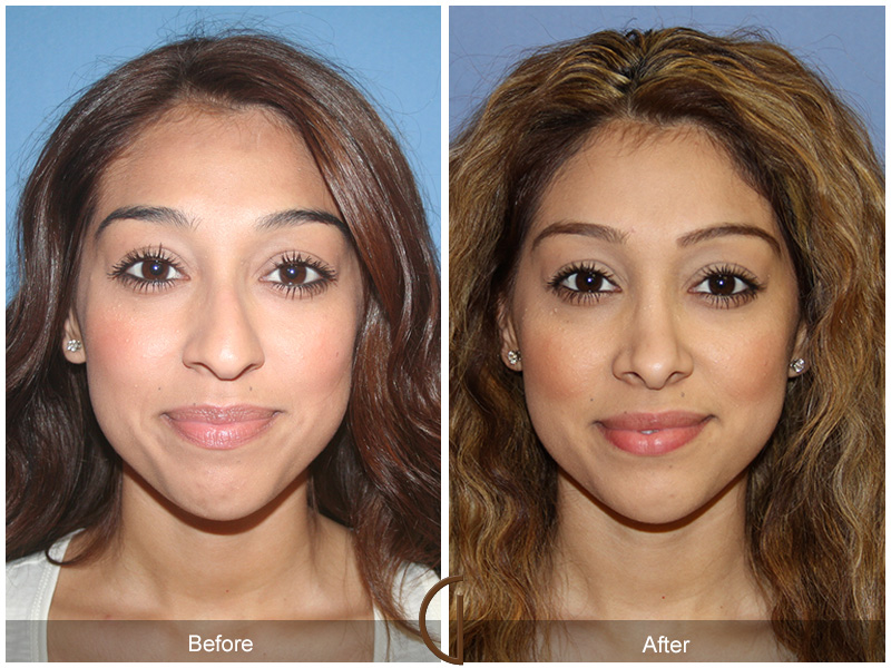 Female Rhinoplasty Before & After Image