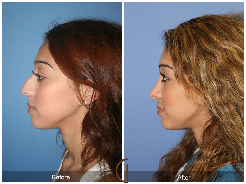 Female Rhinoplasty Before & After Image