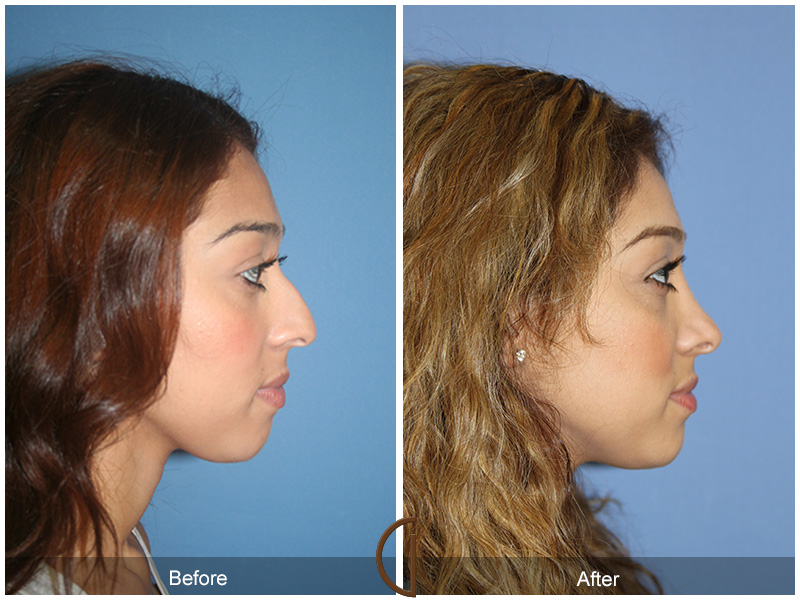 Female Rhinoplasty Before & After Image