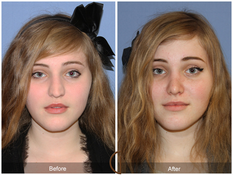 Female Rhinoplasty Before & After Image